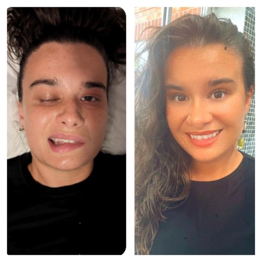 Before and after CACI treatment at The Chase CACI clinic for Bell's palsy