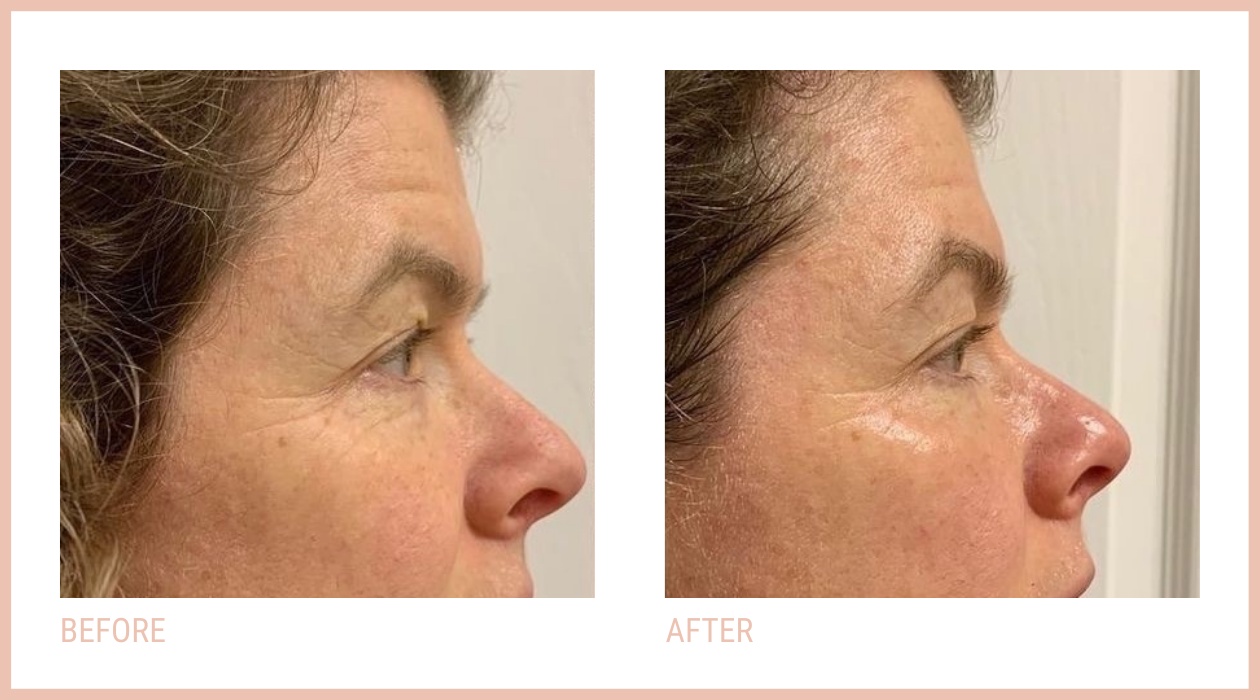 Before and after CACI Eye Revive treatment