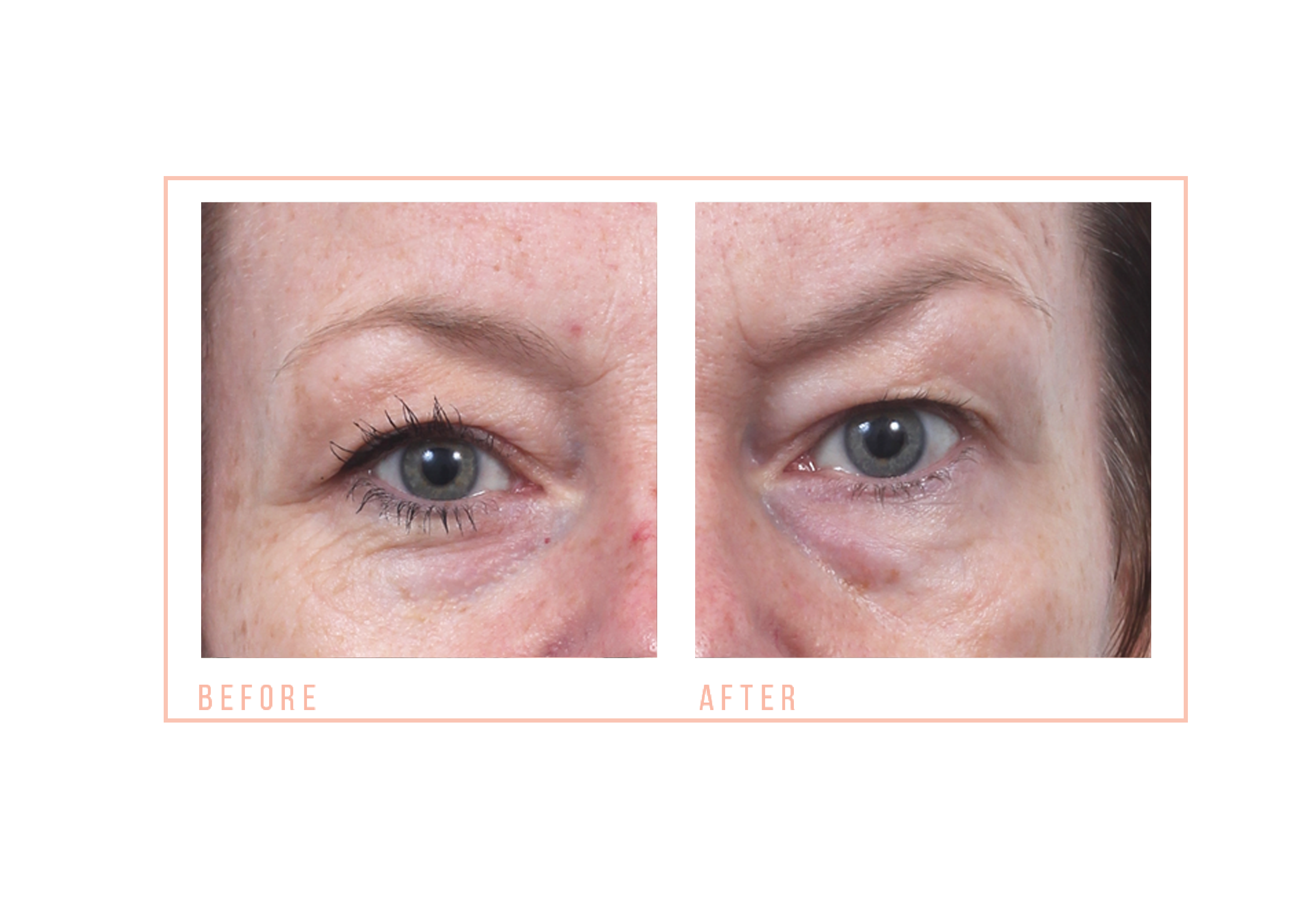 Before and after CACI eyebrow lift treatment