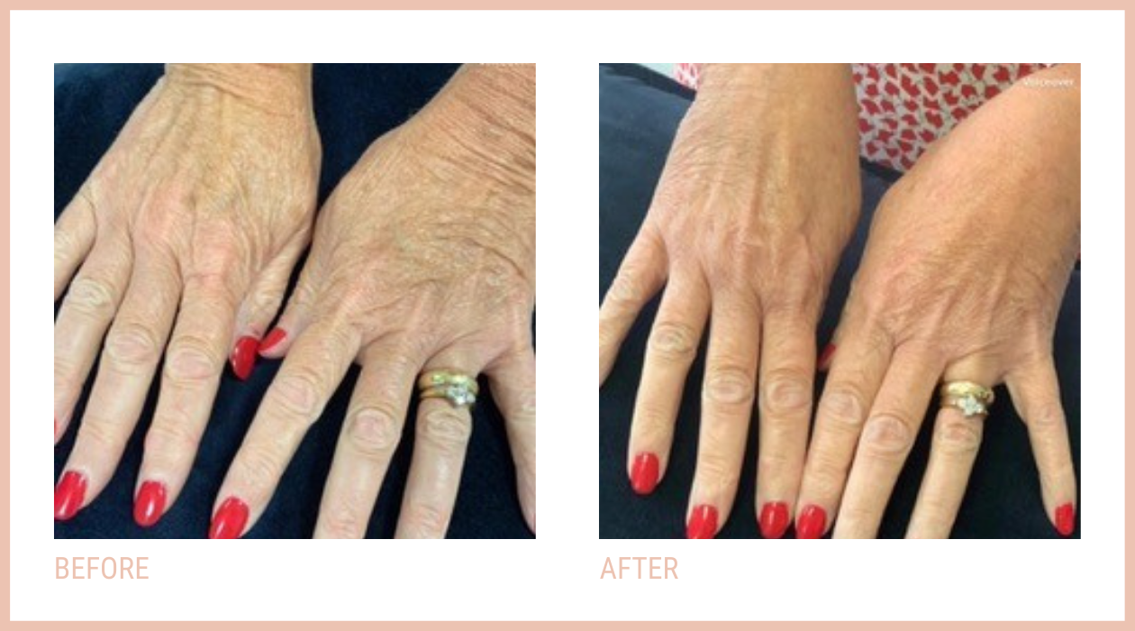 Before and after CACI hand rejuvenation treatment