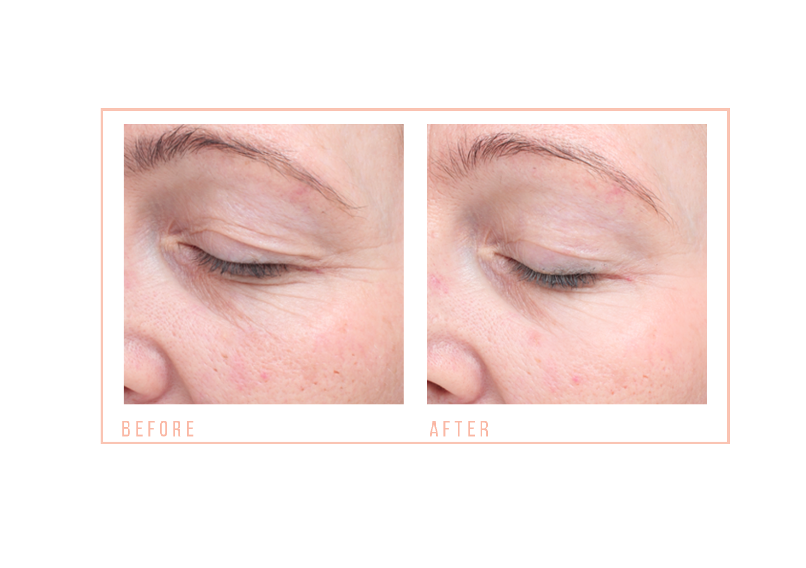 Before and after CACI treatment for hooded eyes