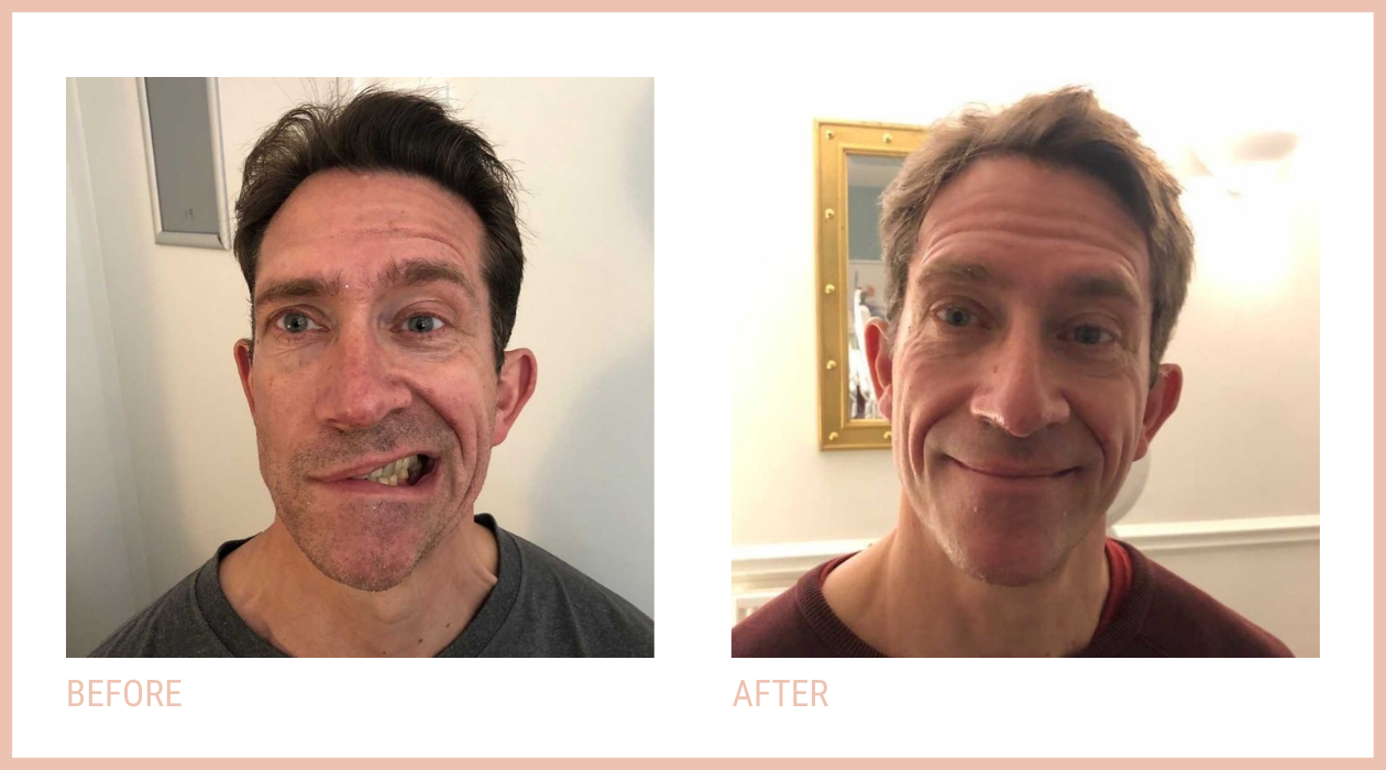 Before and after targeted CACI facial microcurrent treatment